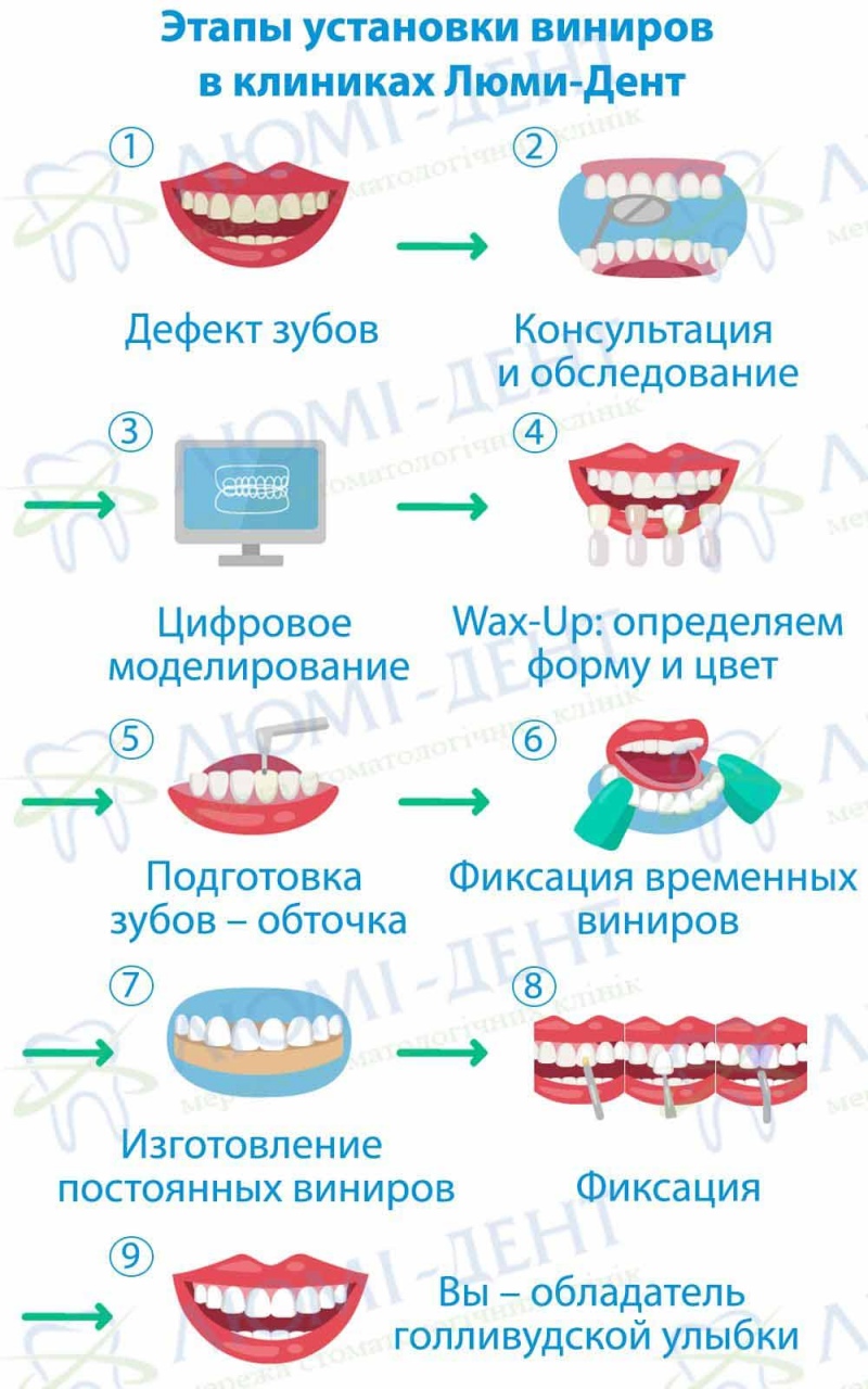 Этапы изготовления виниров в клиниках Люми-Дент Виниры на зубы фото Люми-Дент