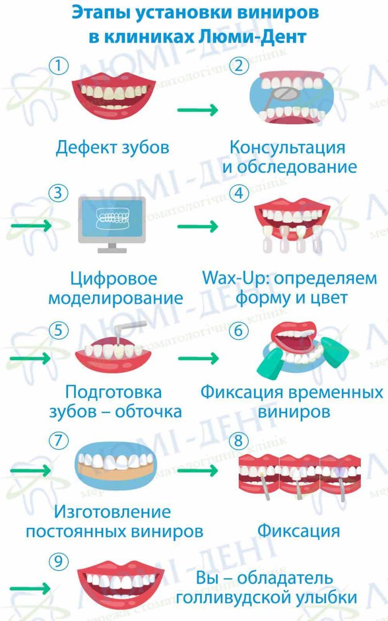 Этапы изготовления виниров в клиниках Люми-Дент Виниры на зубы фото Люми-Дент