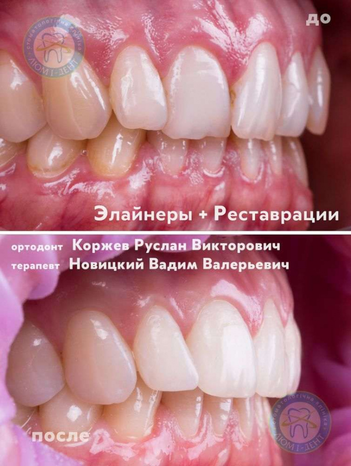 Как выглядит правильный прикус зубов фото Киев Люми-Дент