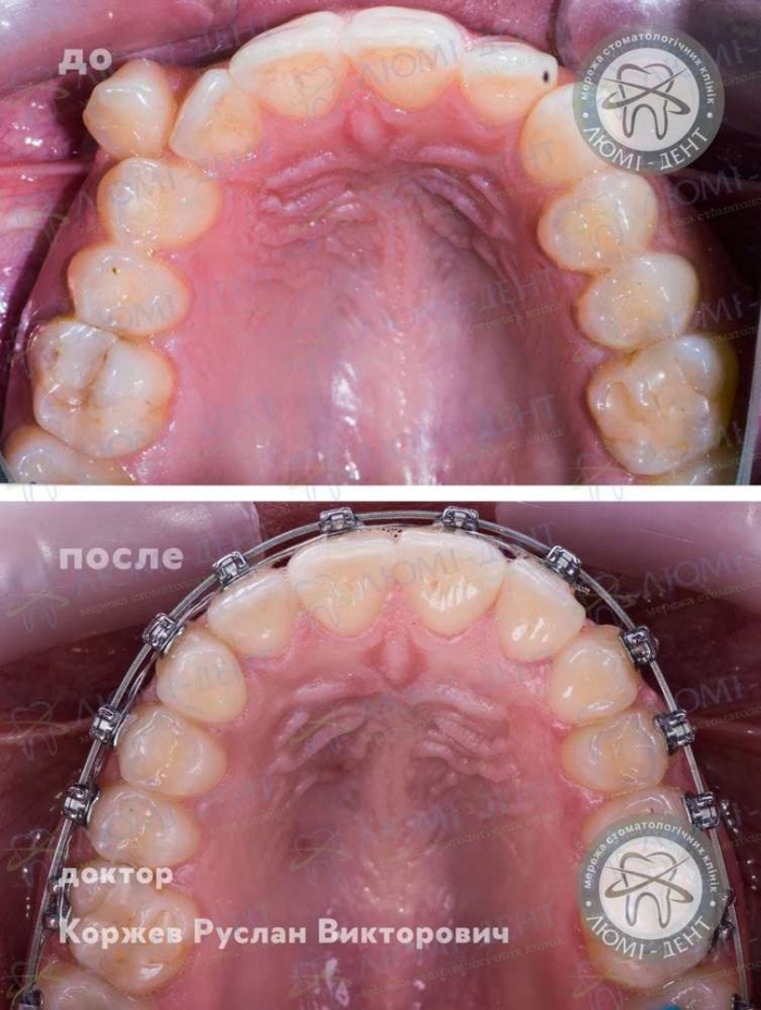 прикус це фото Люмі-Дент