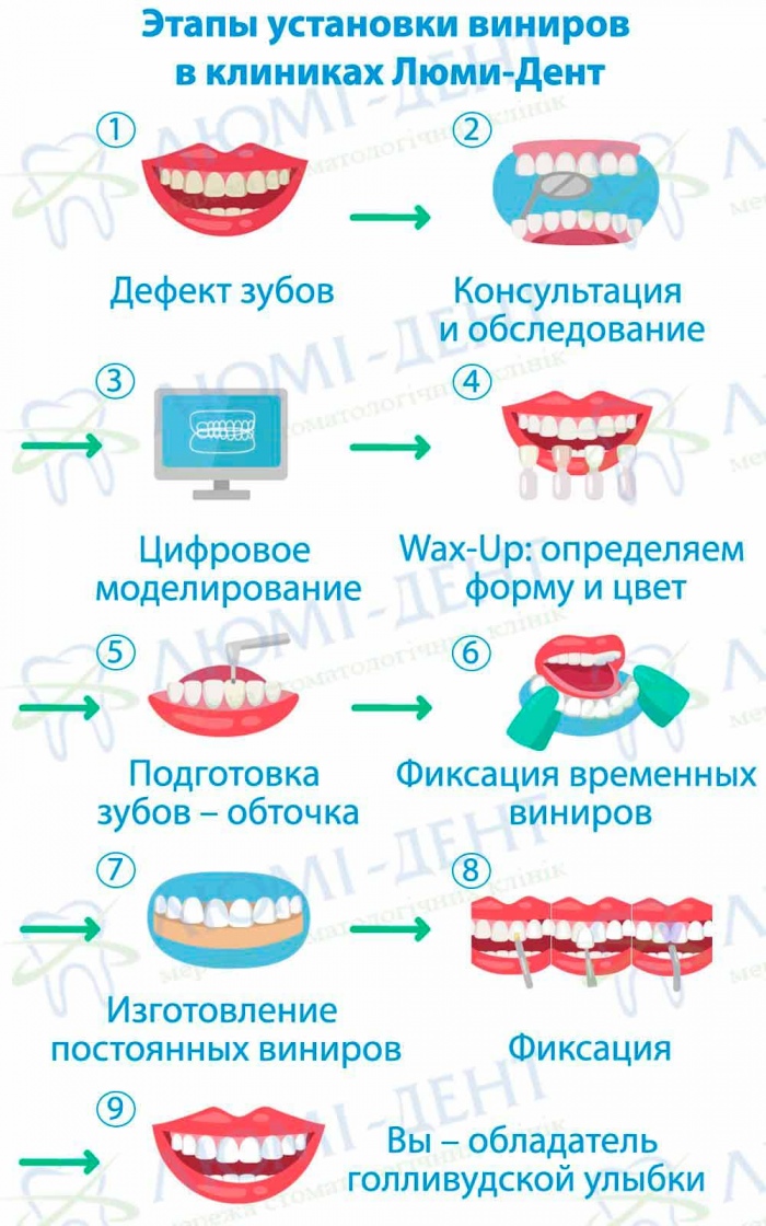 Виниры на зубы фото Люми-Дент