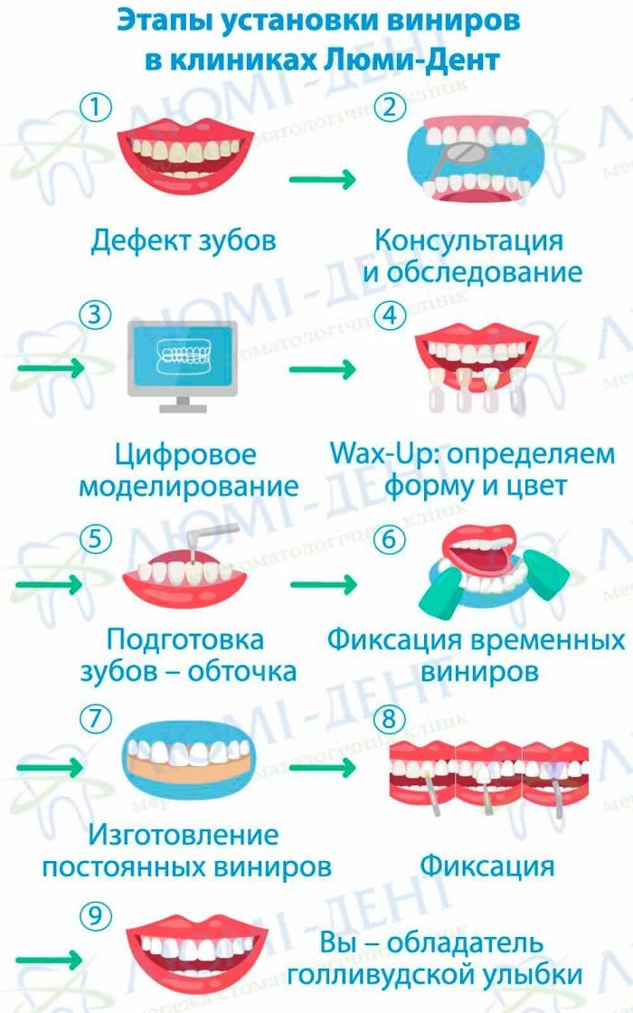 Этапы изготовления виниров в клиниках Люми-Дент