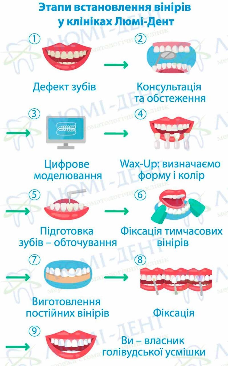 Етапи виготовлення вінірів у клініках Люмі-Дент Етапи виготовлення вінірів у клініках Люмі-Дент