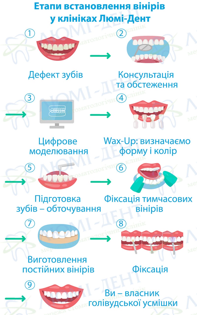 Етапи виготовлення вінірів у клініках Люмі-Дент Етапи виготовлення вінірів у клініках Люмі-Дент