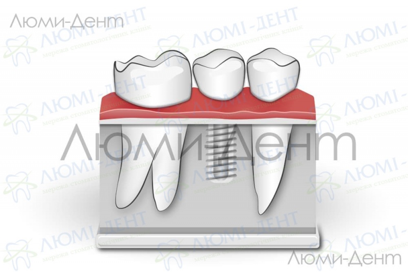 Импланты зубов виды цены Киев фото Люми-Дент 