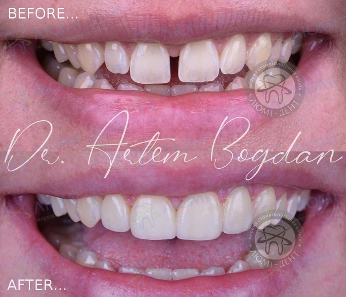 Вінір з США встановлення на зуби фото київ Люмі-Дент