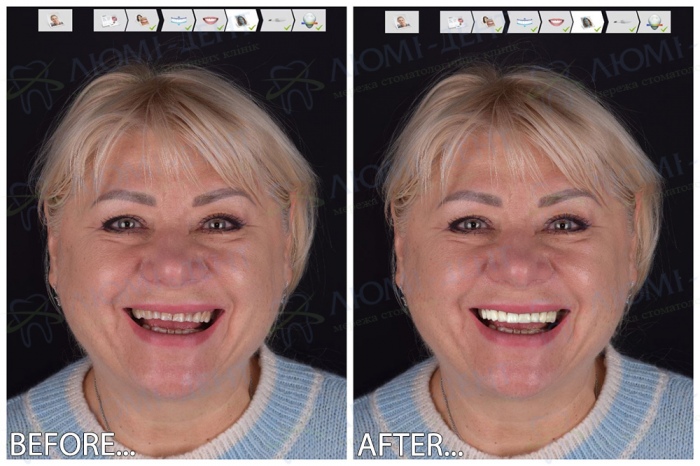 Digital Smile Design Люми-Дент