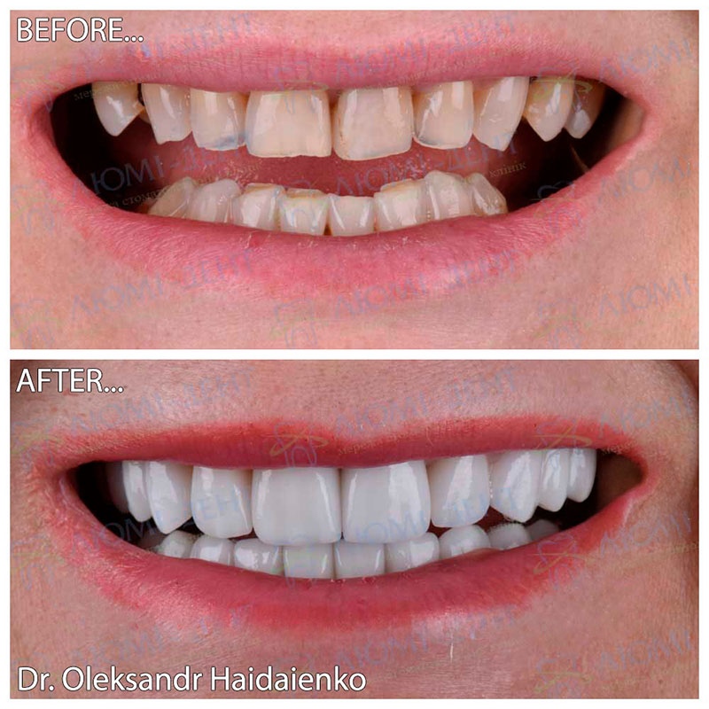 Dental Veneers Lumi-Dent