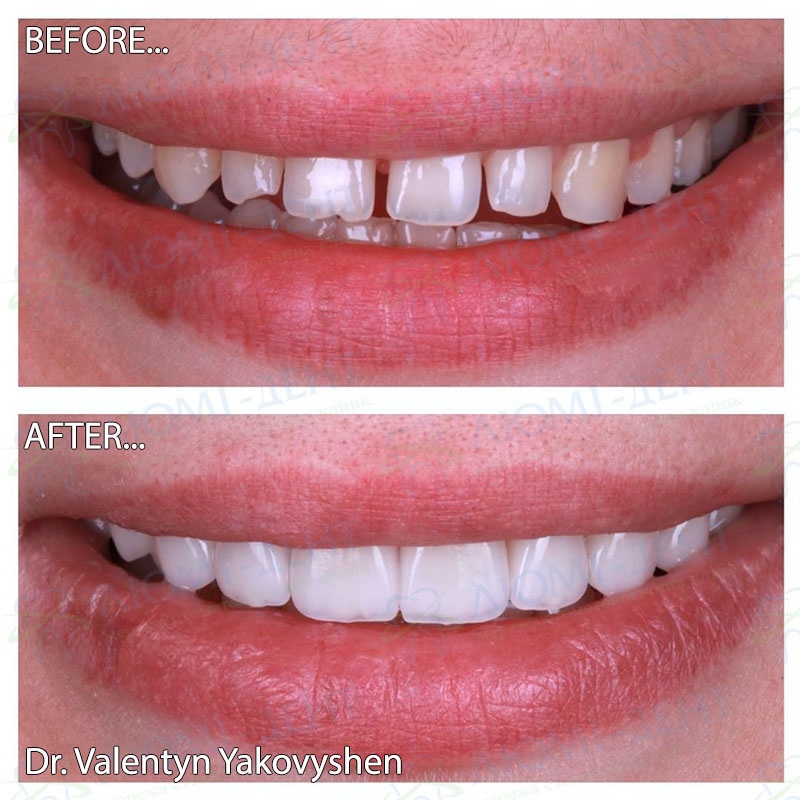 Dental Veneers Lumi-Dent