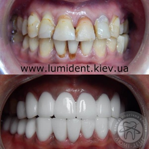 Porcelain veneers without preparation photo reviews price Lumident