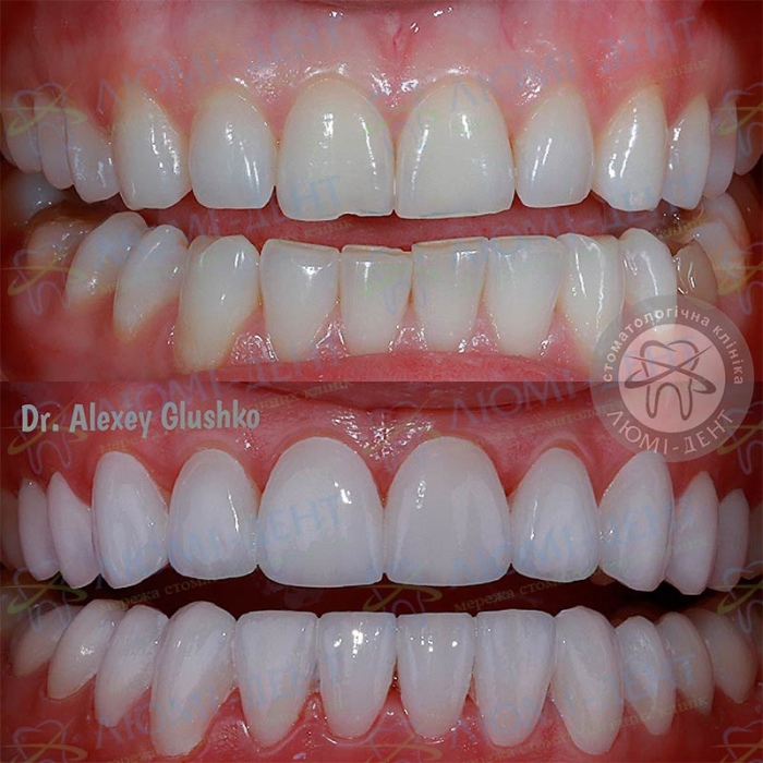 Teeth veneers photo pics Lumi-Dent
