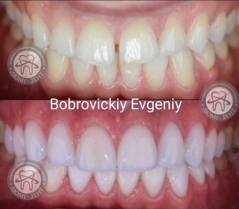 Veneers for teeth price before and after photos reviews Kyiv Lumident