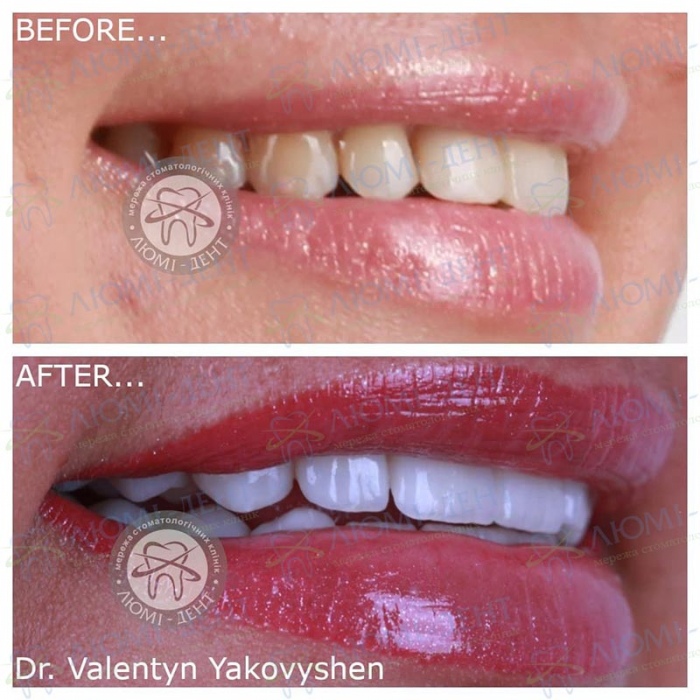Veneers on teeth before and after photos price Kyiv pics Lumi-Dent