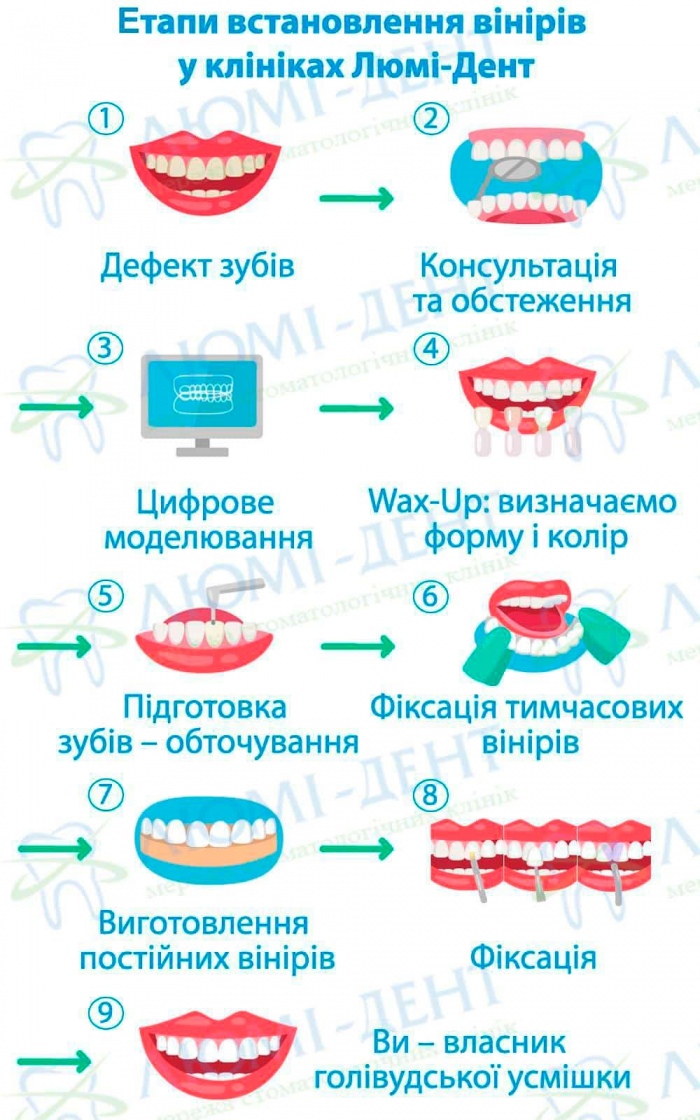 Етапи виготовлення вінірів у клініках Люмі-Дент Етапи встановлення вінірів