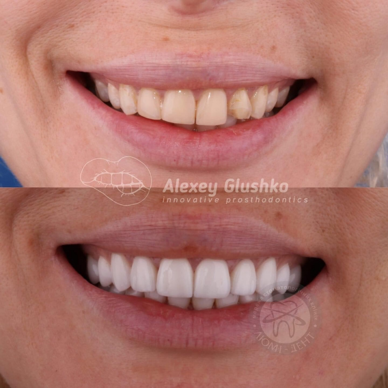 Veneers Lumi-Dent