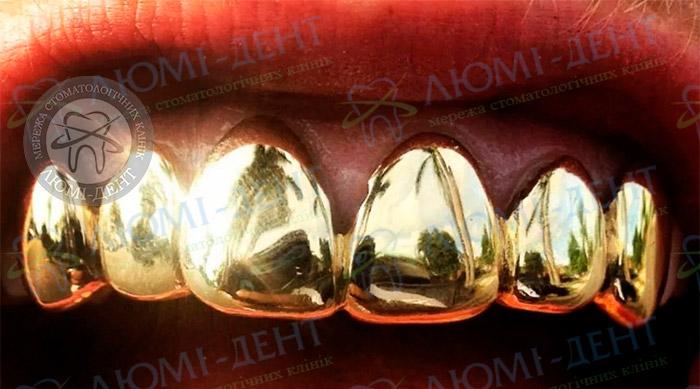 Золоті зуби у пацієнта скільки коштує золотий зуб фото Люмі-Дент