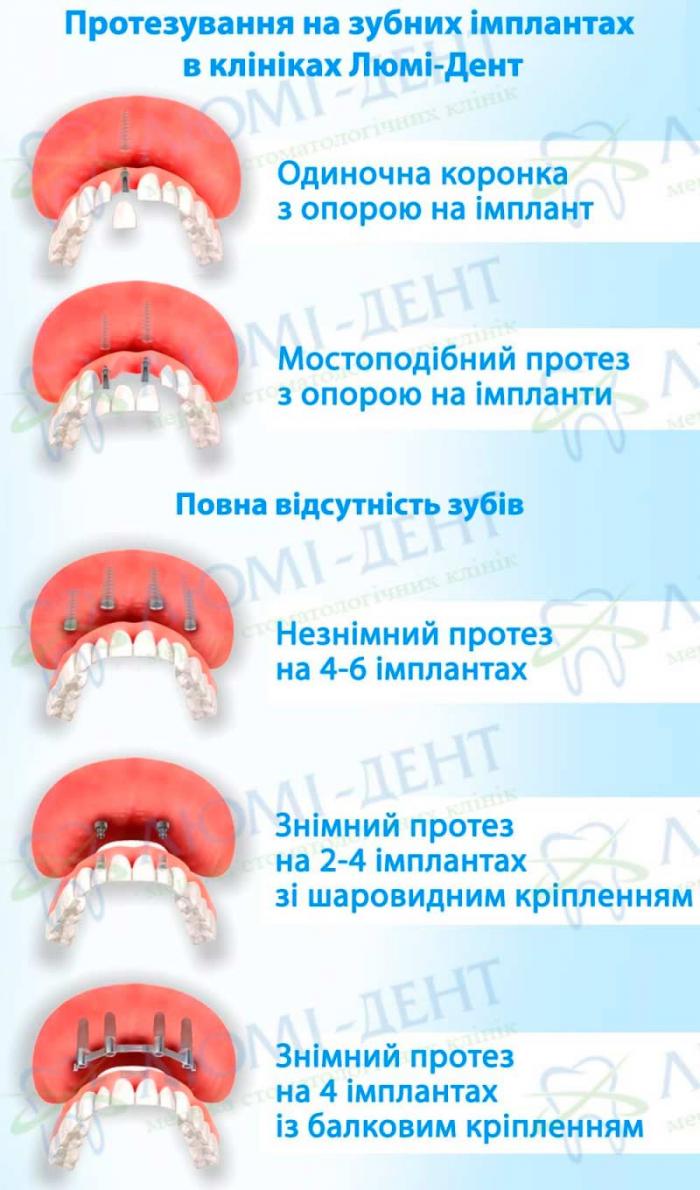 Протезування зубів в Люмі-Дент золота коронка фото Люмі-Дент