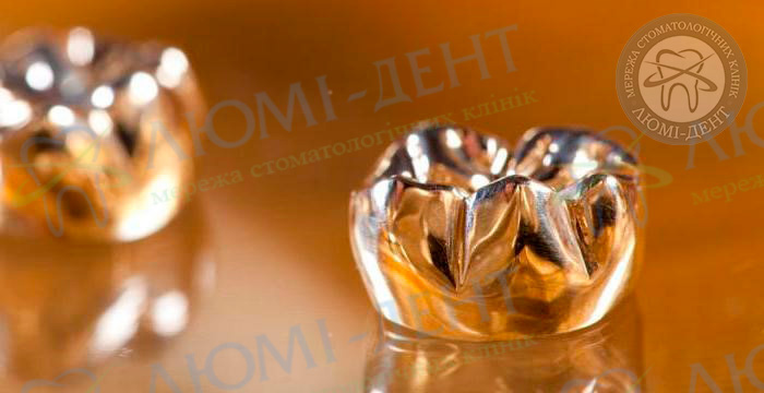 Золотая коронка на зуб фото ЛюмиДент