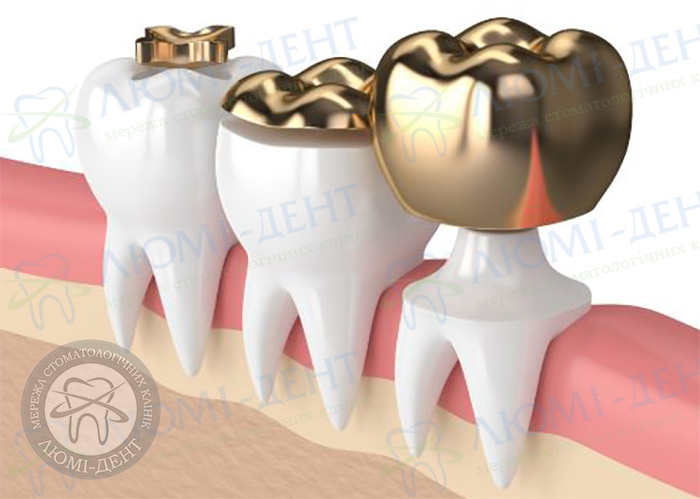 Золотые коронки на зубы фото ЛюмиДент