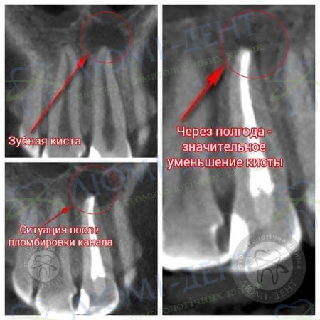 Киста зуба фото Люми-Дент