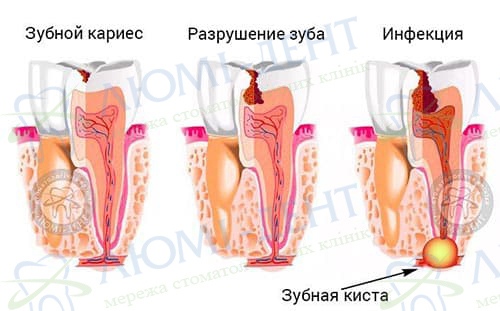 Зубная киста лечение фото Люми-Дент