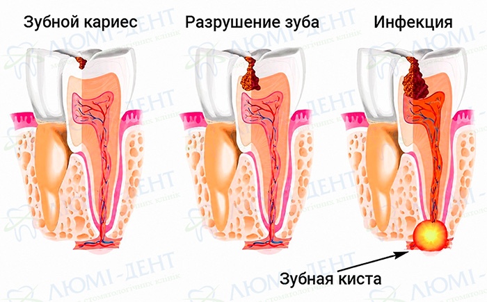 Зубная киста лечение фото Люми-Дент
