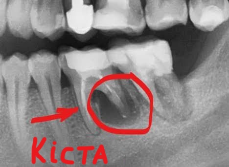 Кіста в зубі фото Люмі-Дент
