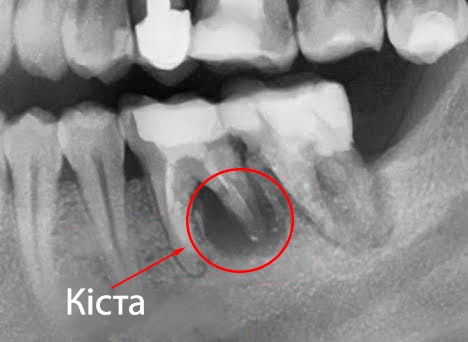 Фото зубної кісти на рентгені Кіста в зубі фото Люмі-Дент