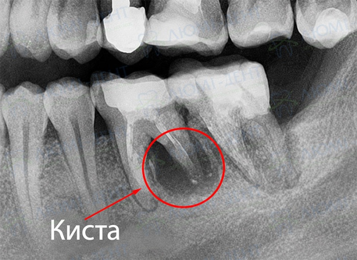 Зубная киста фото Люми-Дент