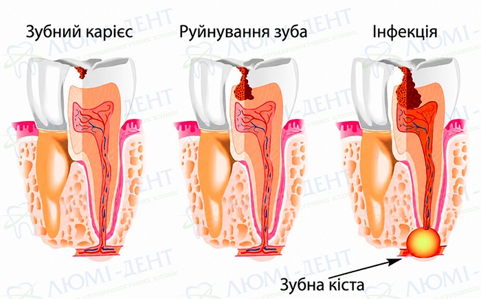 Скільки коштує операція по видаленню кісти зуба фото Люмі-Дент
