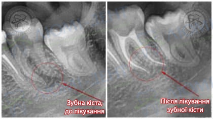 Зубна кіста фото Люмі-Дент