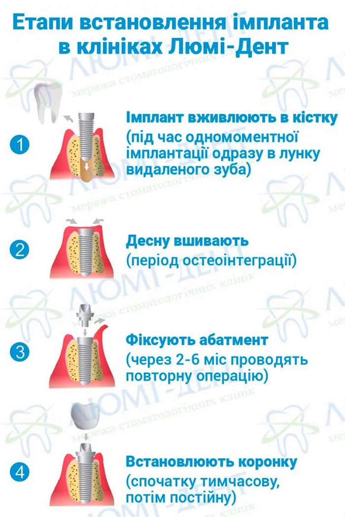 Зубні імпланти українського виробництва Фото ЛюміДент