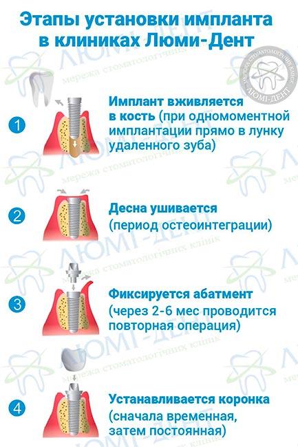 Этапы установки имплантов в клинике Люми-Дент Этапы установки имплантов в клинике Люми-Дент