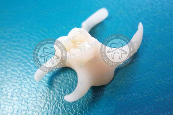 Частковий знімний протез на один зуб фото Люмі-Дент