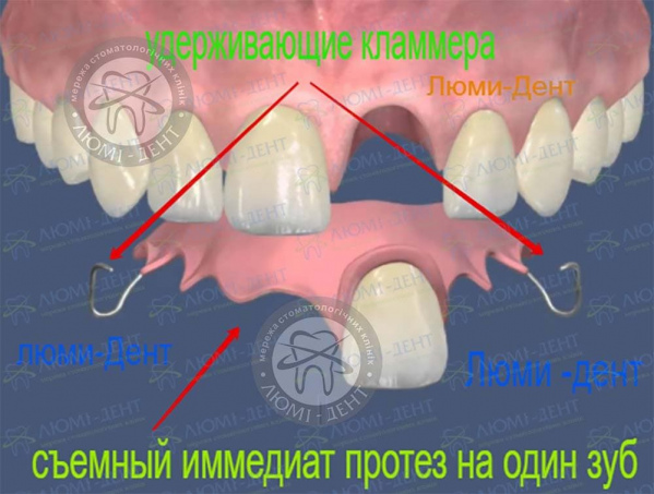 Съемный иммедиат протез на один зуб фото Люми-Дент