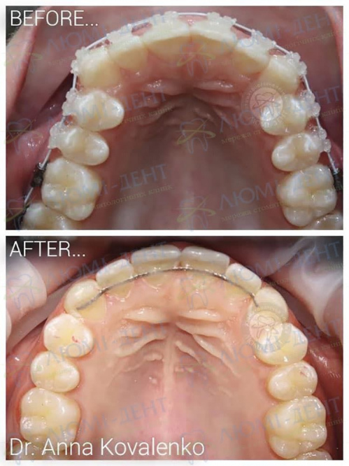 Зубы после брекетов фото Люми-Дент
