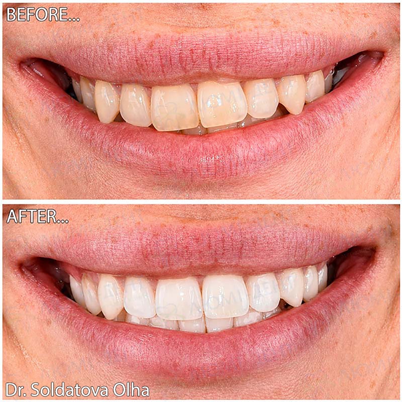 Результат виправлення прикусу елайнерами Виправлення прикусу капами GetSmile Люмі-Дент