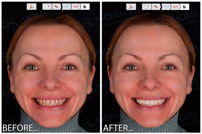 Digital Smile Design - DSD Digital Smile Design - DSD