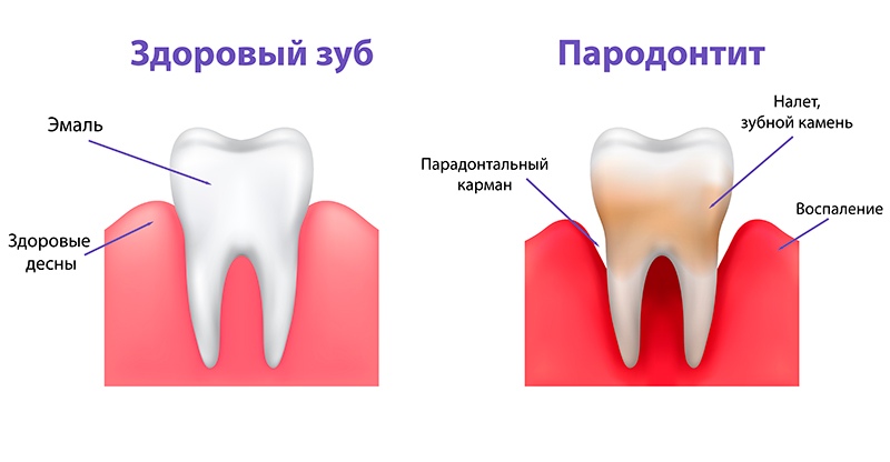 Схема развития пародонтита Пародонтит фото Люми-Дент