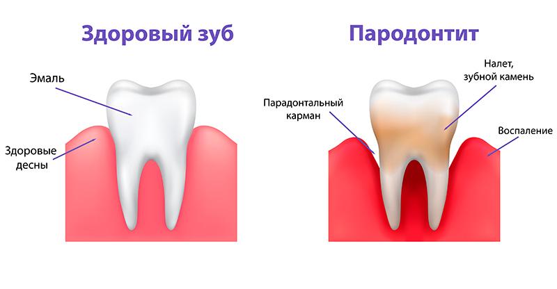 Схема развития пародонтита Пародонтит фото Люми-Дент