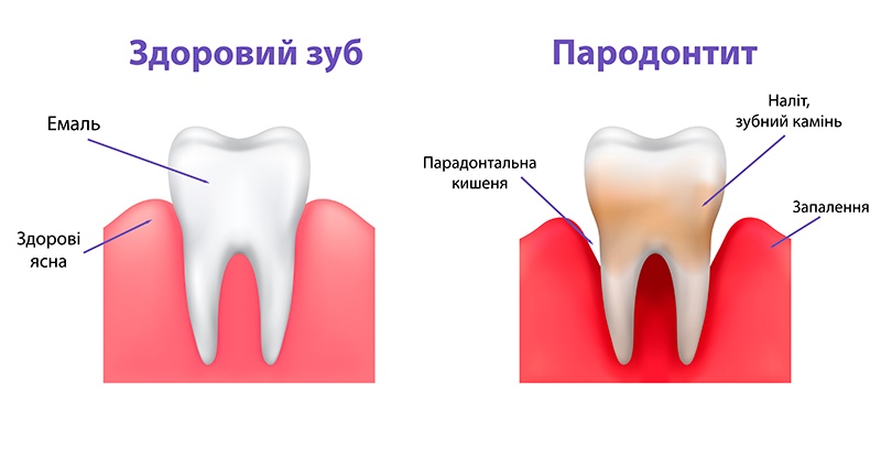 Пародонтит фото Люмі-Дент
