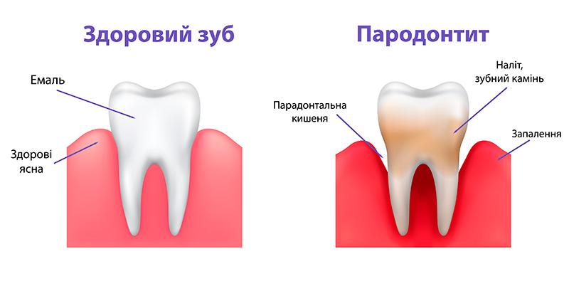 Схема розвитку пародонтиту Пародонтит фото Люмі-Дент
