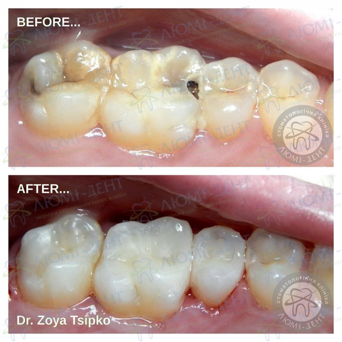 Tooth treatment photo LumiDent