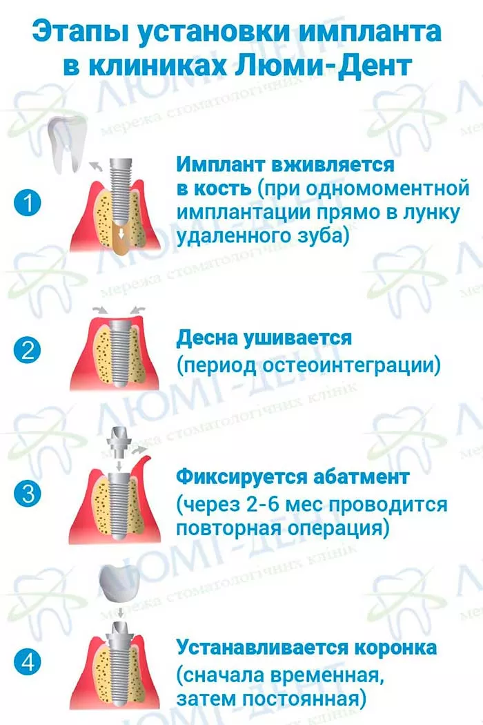 Этапы установки импланта в Люми-Дент