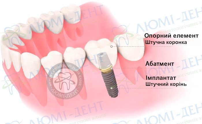 Корейські імпланти відгуки фото ЛюміДент