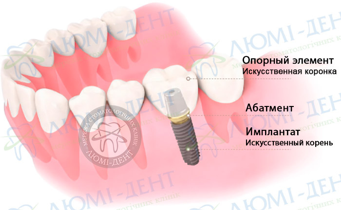 Оsstem импланты фото ЛюмиДент