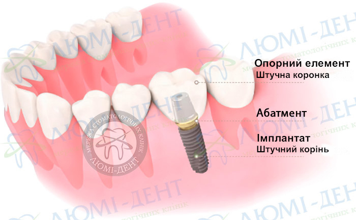 Оsstem імпланти фото ЛюміДент