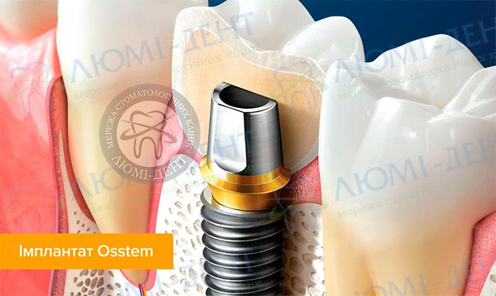 Зубні імпланти Оsstem фото ЛюміДент