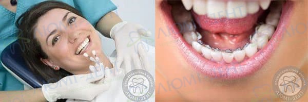 Зуби після брекетів фото Люмі-Дент