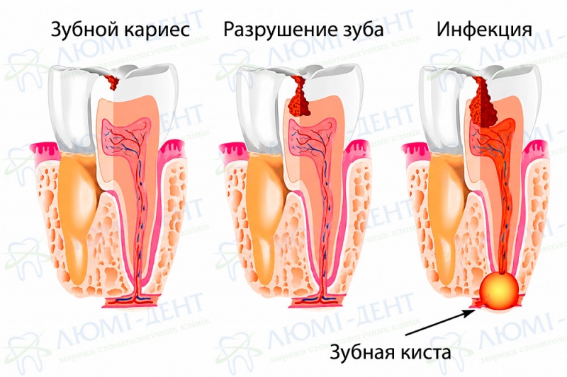 Появление зубной кисты Резекция зуба фото Люми-Дент